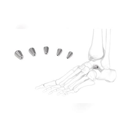 Subtalar Joint Implant