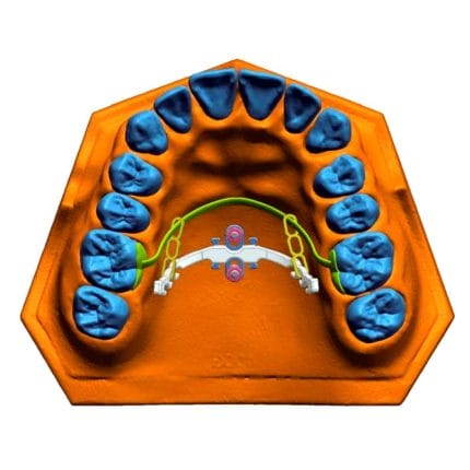 Tapered Dental Implant 1