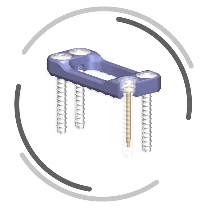 Thoraco-Lumbar Arthrodesis Plate