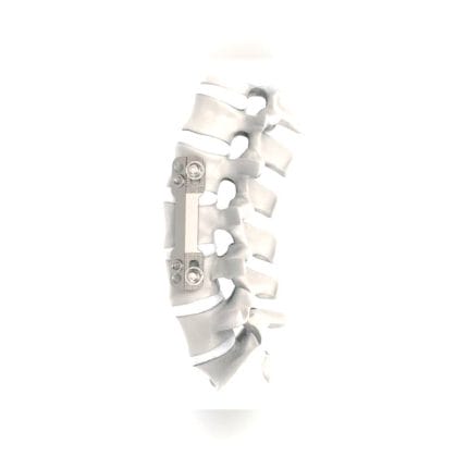 Thoraco-Lumbar Arthrodesis Plate 1