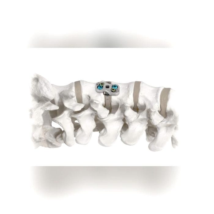 Thoraco-Lumbar Arthrodesis Plate 1