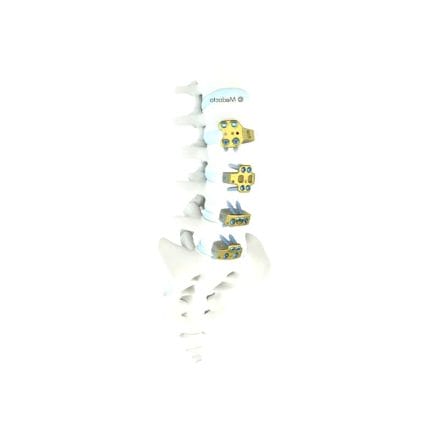 Thoraco-Lumbar Interbody Fusion Cage