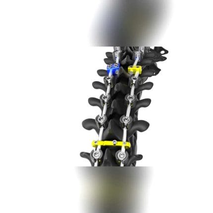 Thoraco-Lumbar Pedicle Screw 1