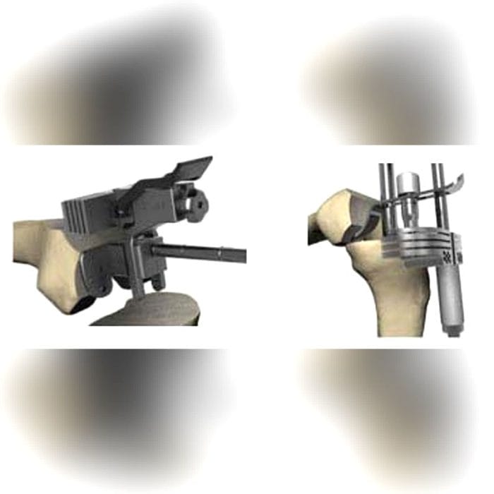 Three-Compartment Knee Prosthesis 4