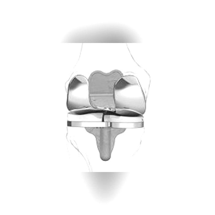 Three-Compartment Knee Prosthesis 5