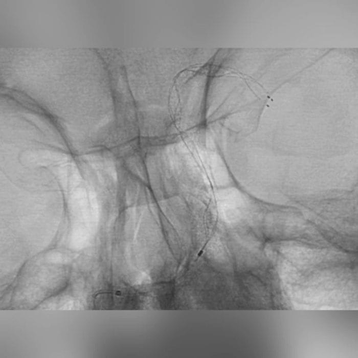 Thrombectomy Catheter 2