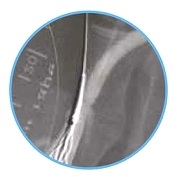 Thrombectomy Catheter 2