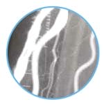 Thrombectomy Catheter 3