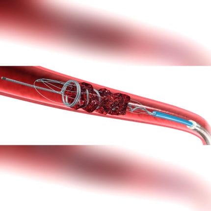 Thrombectomy Catheter 1