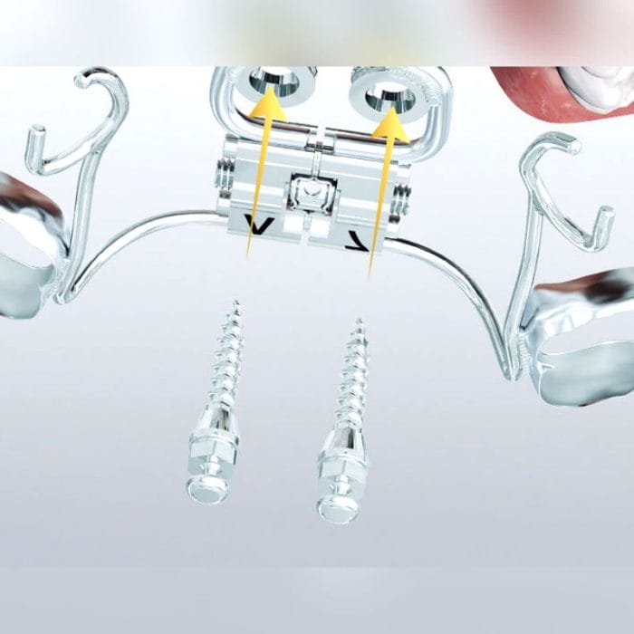 Titanium Dental Implant 1