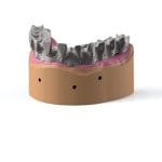 Titanium Dental Prosthesis