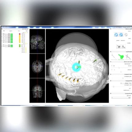 Tms Neuronavigation System 1