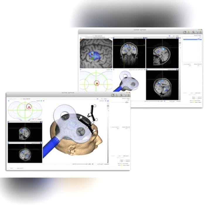 Tms Neuronavigation System 2