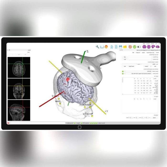 Tms Neuronavigation System 1