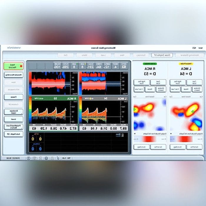 Transcranial Doppler 2