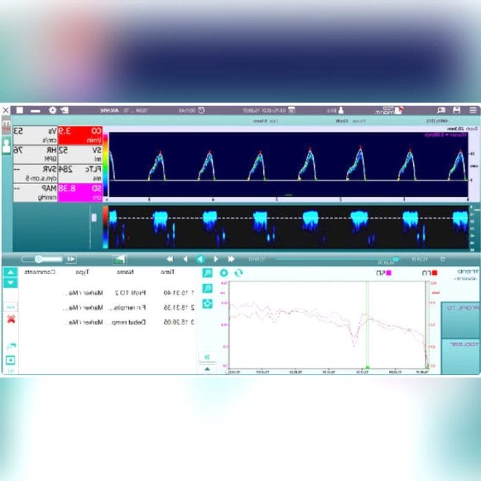 Transcranial Doppler 2