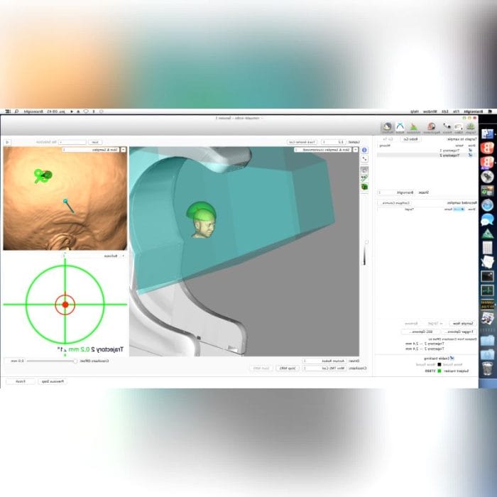 Transcranial Magnetic Stimulator 2