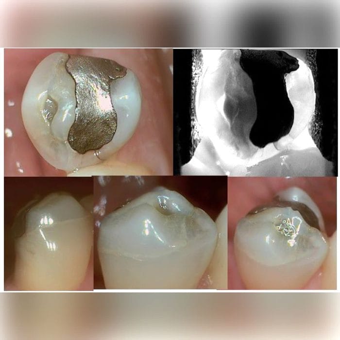 Transillumination Caries Detector 2