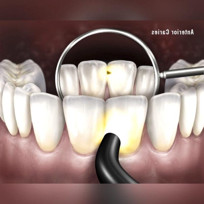 Transillumination Caries Detector 4