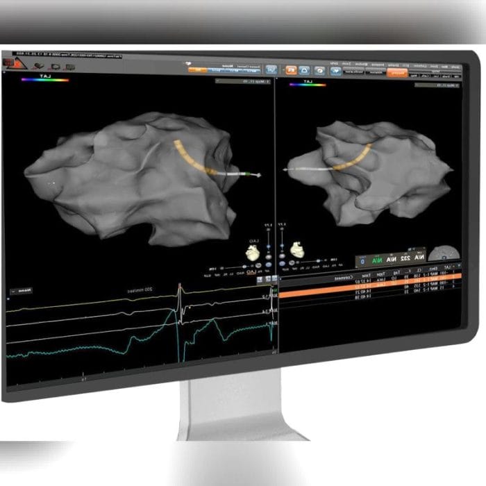 Transseptal Access Sheath 3