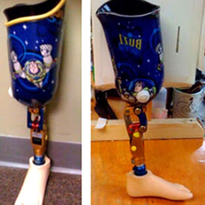 Transtibial Prosthetic Socket