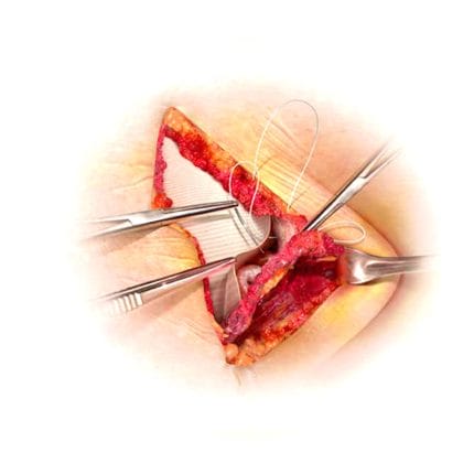 Umbilical Hernia Prosthesis 1