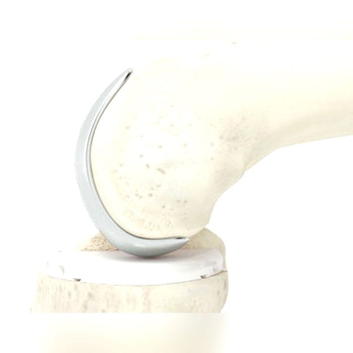 Unicompartmental Knee Prosthesis 6