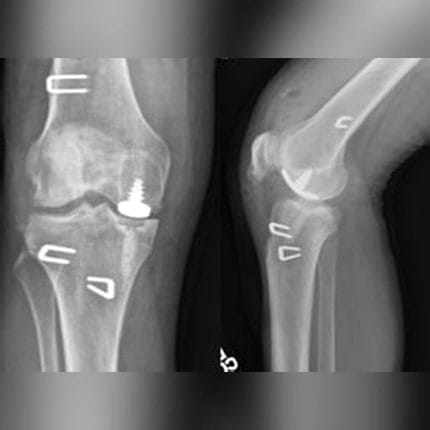 Unicompartmental Knee Prosthesis 1