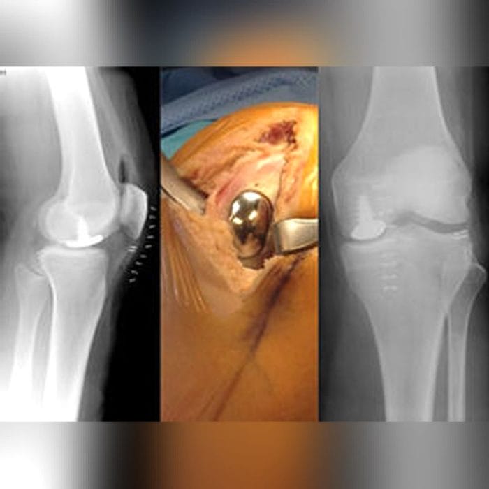 Unicompartmental Knee Prosthesis 2