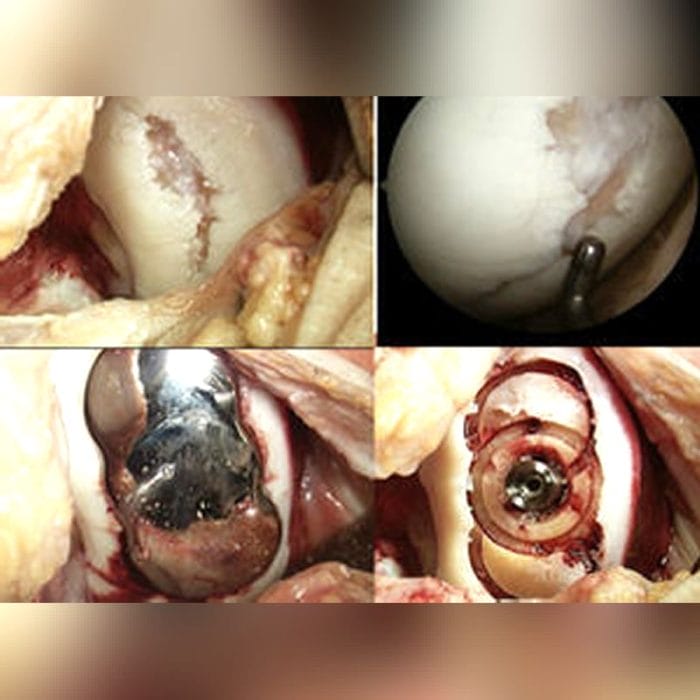 Unicompartmental Knee Prosthesis 3