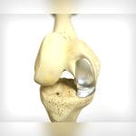 Unicompartmental Knee Prosthesis 1