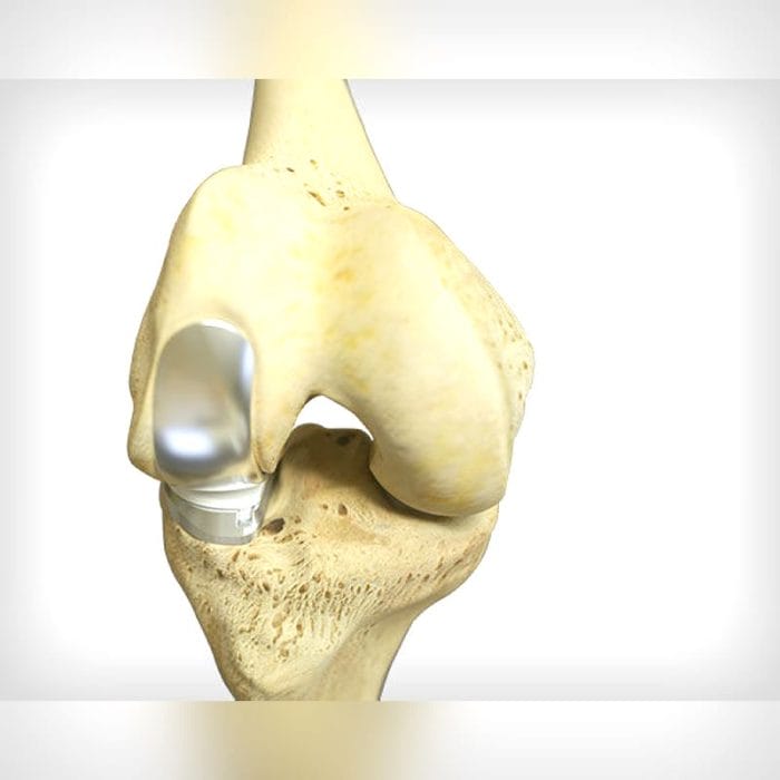 Unicompartmental Knee Prosthesis 2