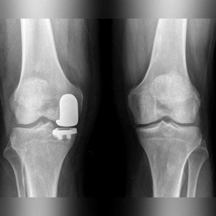 Unicompartmental Knee Prosthesis 3