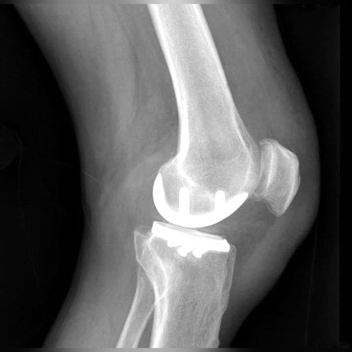 Unicompartmental Knee Prosthesis 4