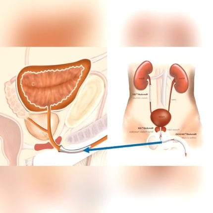 Urethral Stent 1