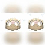 Urinary Incontinence Reconstruction Mesh 3