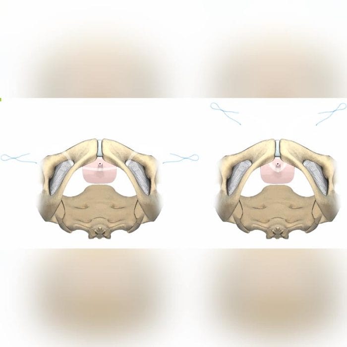 Urinary Incontinence Reconstruction Mesh 3