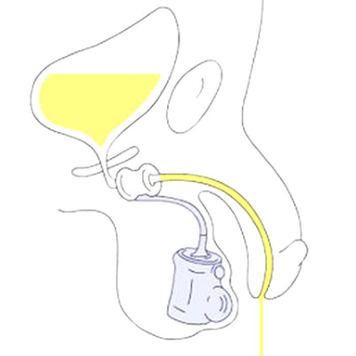 Vesical Sphincter Prosthesis 5