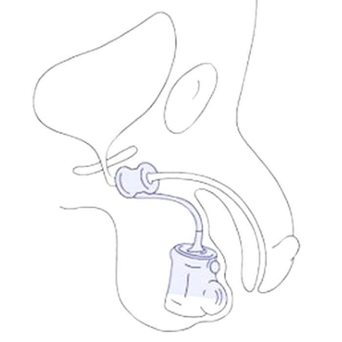 Vesical Sphincter Prosthesis 6