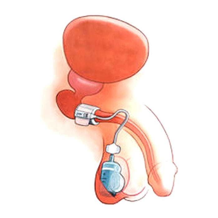 Vesical Sphincter Prosthesis