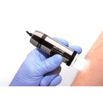 Video Dermatoscope