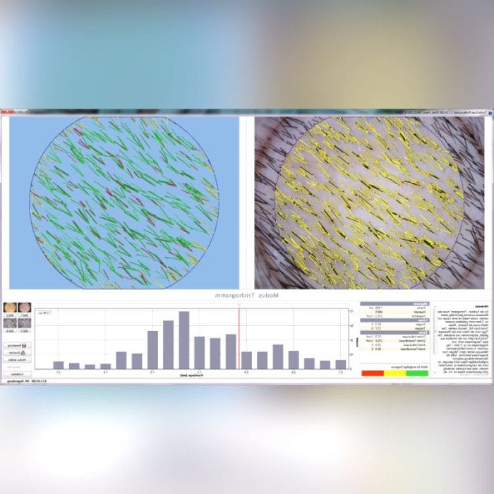 Video Trichoscope 1