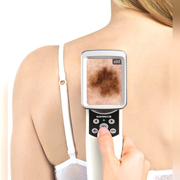 White Led Dermatoscope 2