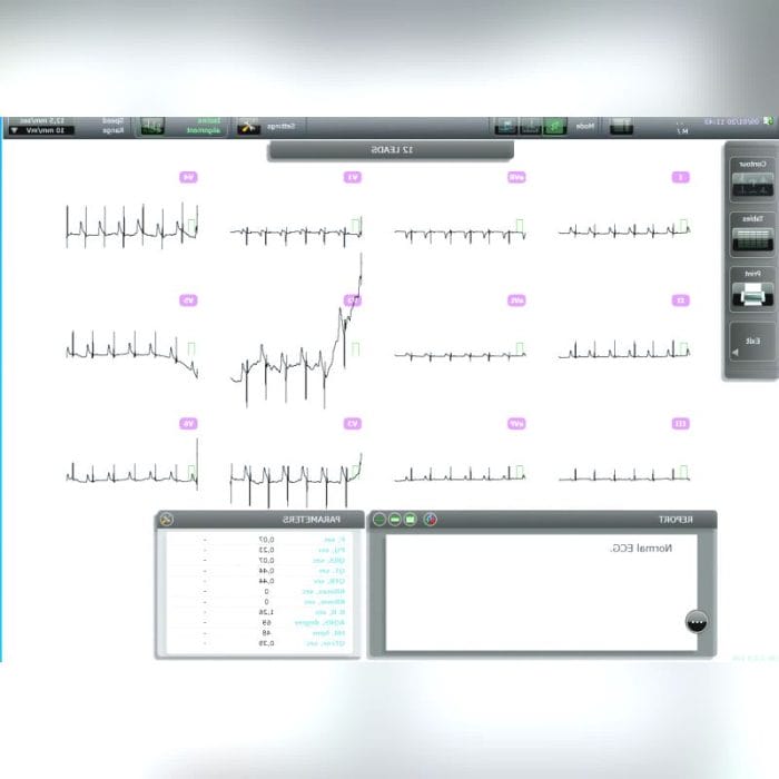 Wireless Ecg Event Recorder 6