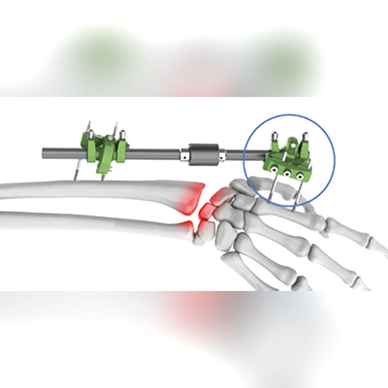 Wrist External Fixation System 1