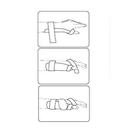 Wrist Orthosis 1